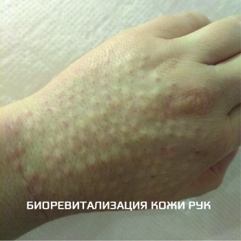 Биоревитализация любой зоны
                    Косметолог-ін'єкціоніст Елена Київ