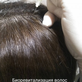 Биоревитализация любой зоны
                    Косметолог-ін'єкціоніст Елена Київ