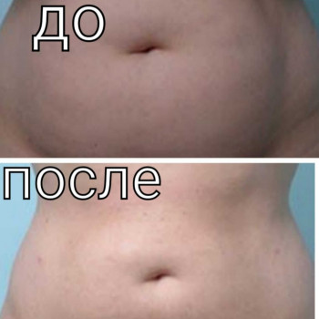 Липолитики
                    Косметолог-ін'єкціоніст Елена Київ