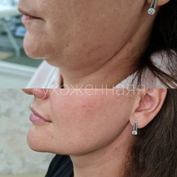 Липолитики