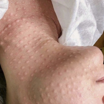 Биоревитализация лица
                    Лікар-косметолог Наталья Київ