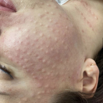 Биоревитализация лица
                    Лікар-косметолог Наталья Київ