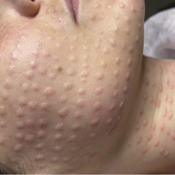 Биоревитализация лица
                    Лікар-косметолог Наталья Київ