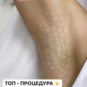 Лечение гипергидроза
                    Лікар-косметолог Наталья Київ