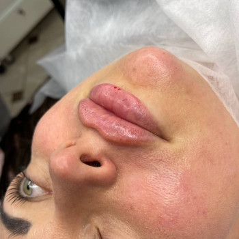 Контурная пластика губ!
Классика ,плоский бант!