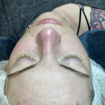 Комбинированная чистка лица