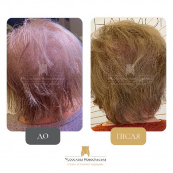 Лікування випадіння волосся