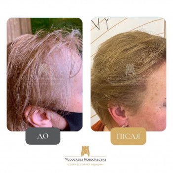 Лікування випадіння волосся
