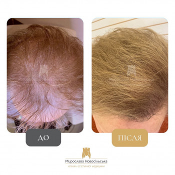 Лікування випадіння волосся