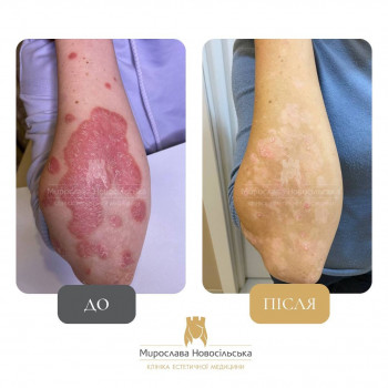 Лазерне лікування псоріазу