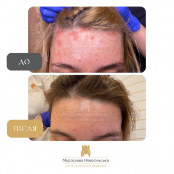 Лазерне лікування псоріазу