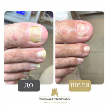 Лазерне лікування грибка нігтів