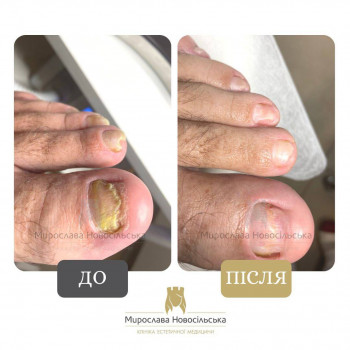 Лазерне лікування грибка нігтів