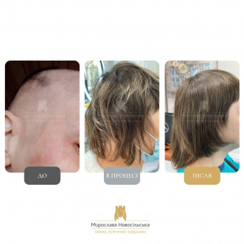 Лікування випадіння волосся