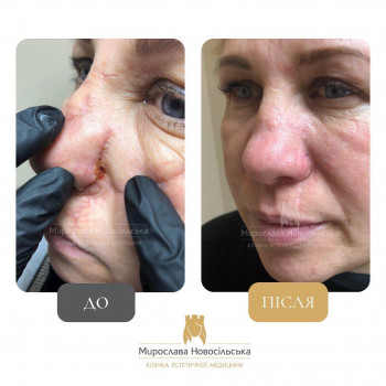 Лікування шрамів та рубців безопераційним методом