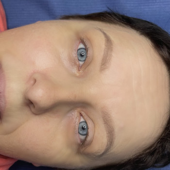 Загоєні брови перед корекцією