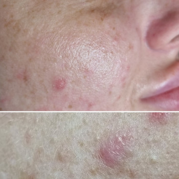 Чистка лица, Hydrofacial, ультразвуковая, механическая чистка
                    Косметолог-эстетист Влада Харьков