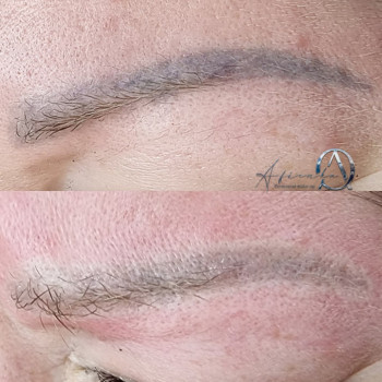 Видалення татуажу
                    Косметолог-эстетист Ольга Киев