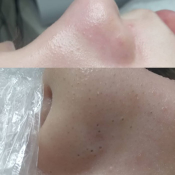 Комбінована чистка обличчя
    #