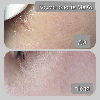 Видалення судни діодним дерматологічним лазерем
   