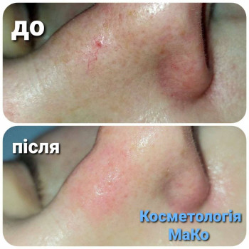 Видалення судни діодним дерматологічним лазерем
   