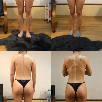 Результат 5 сеансів вакуумно-роликового масажу