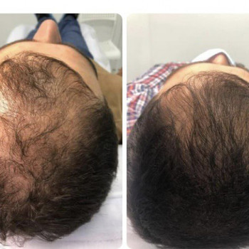 Мезотерапія волосистої частини голови
                    Косметологический центр МаКо Киев