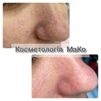 Мануальна/комбінована чистка обличчя + терапевтичний пілінг
                    Косметологический центр МаКо Киев