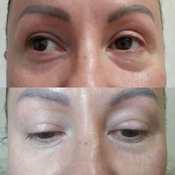 маска, сыворотка от отеков и темных кругов+электропарация