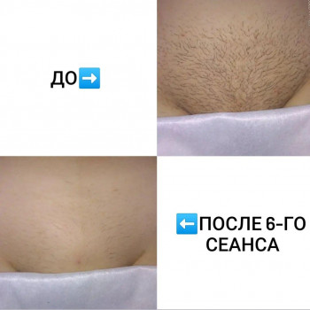 депиляция, лазерная эпиляция