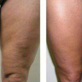 Кавітація/Лазерний ліполіз/RF-ліфтинг
                    Косметологический центр МаКо Киев