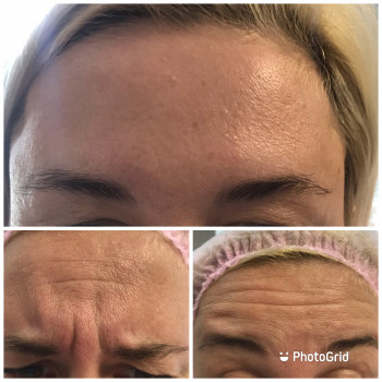 Ботулінотерапія