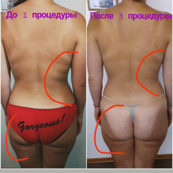 Аппаратный вакуумно-ролликовый массаж
                    Мастер маникюра Лариса Кропивницкий