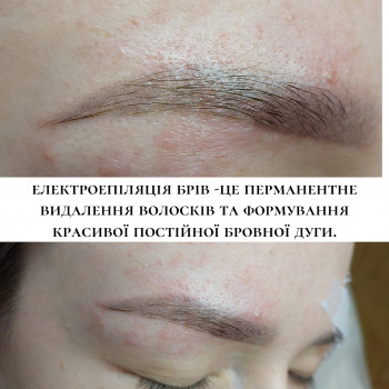 Електроепіляція обличчя - 12 грн / 1хв
                    Косметолог Юлія Киев