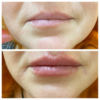 Увлажнение, увеличение губ. Коррекция ассиметрии, маскировка