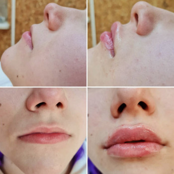 Увеличение губ. Плоский бант