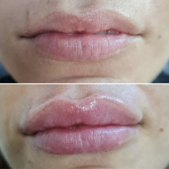 Увеличение губ. Коррекция ассиметрии