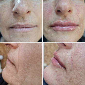 Омоложение и увлажнение губ. Коррекция ассиметрии