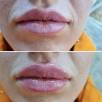 Коррекция ассиметрии губ