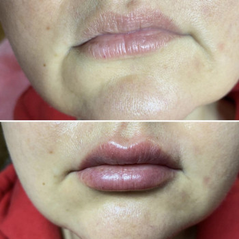 Придание обьема губам. Коррекция формы