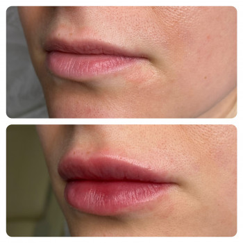 Контурна корекція губ