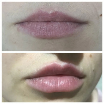 Корекція губ