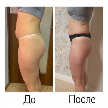 Кавитация (зона живот) + Аппаратный коррекционный массаж с ч