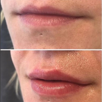 Збільшення губ