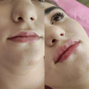 Контурна пластика губ
Alexa Hyalual