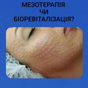 Редермалізація 
Препарат Hyalual Booster 2,2%