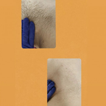 Воскова депіляці лобкової ділянки