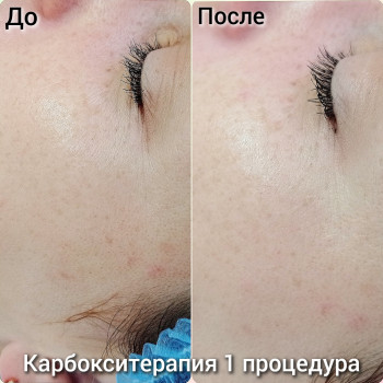 Карбоксітерапія
 