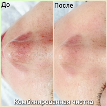 Комбінована чистка
 
 