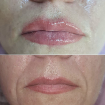 Коррекция губ и носогубных складок. При дуо- процедуре- скид